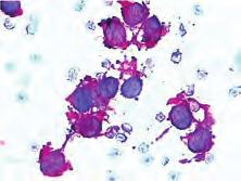 Ovi tumori različitog podrijetla predstavljaju heterogenu skupinu malignih neoplazmi, vrlo sličnih histološki i citološki s prisutnim nediferenciranim, uniformnim, malim okruglim stanicama velikih,