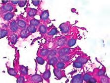 Citološka dijagnoza i subtipizacija tumora malih okruglih stanica povećava se ako se koriste klinički podaci te imunocitokemijska i genetska analiza u određenim slučajevima (9).