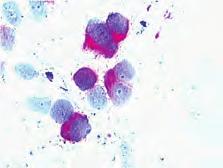 okruglih stanica, slabo vidljivih nukleola, srednje obilne citoplazme uz izvjestan