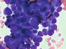 Citološki se radi o nezrelim tumorskim stanicama koje su citokemijski i imunocitokemijski