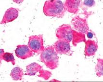 mješavina malih limfocita i krupnih atipičnih retikularnih stanica s prisutnim mitozama (MGG x1000); e) atipične retikularne stanice imunocitokemijski pozitivne na CD30 i f) CD3 (LSAB x1000).