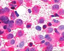 Senzitivnost i specifičnost citologije za tumore malih okruglih stanica prelazi 90% ako je uzorak adekvatan.