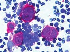 Juvenile Myelomonocytic Leukemia with PTPN11 Mutation in a 23-Month-Old Girl. Coll Antropol 2010;34(1):251-4. 5.
