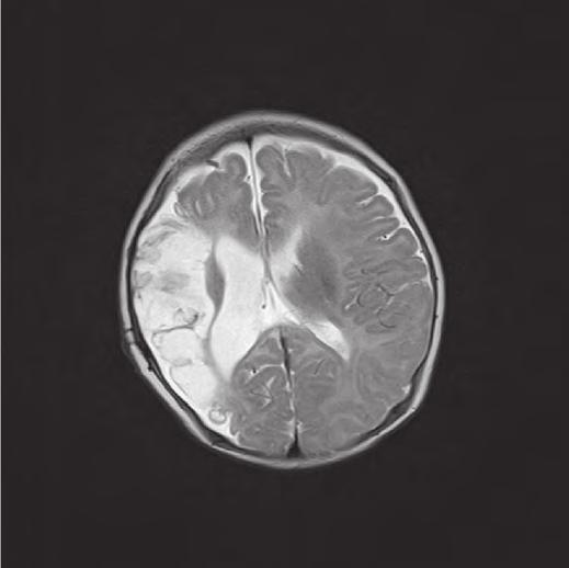 S. Čulić Prikaz tromboze i trombofilije u djeteta Kontrolni nalazi UZV mozga pokazao je desno frontalno, parijetalno i okcipitalno hiperehogenost mliječnog stakla uz stvaranje porencefalične šupljine