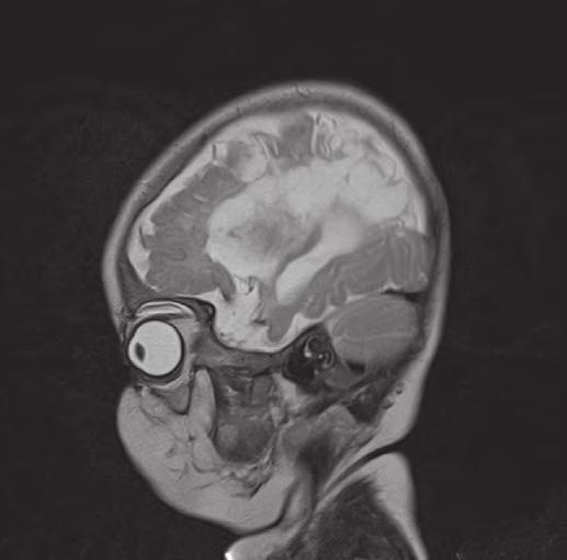 Slika 4. MRI mozga - rezidualni masivni postresorptivni hipodenzitet - porencefalična šupljina u irigaciji desne a. cerebri medije. Slika 2.