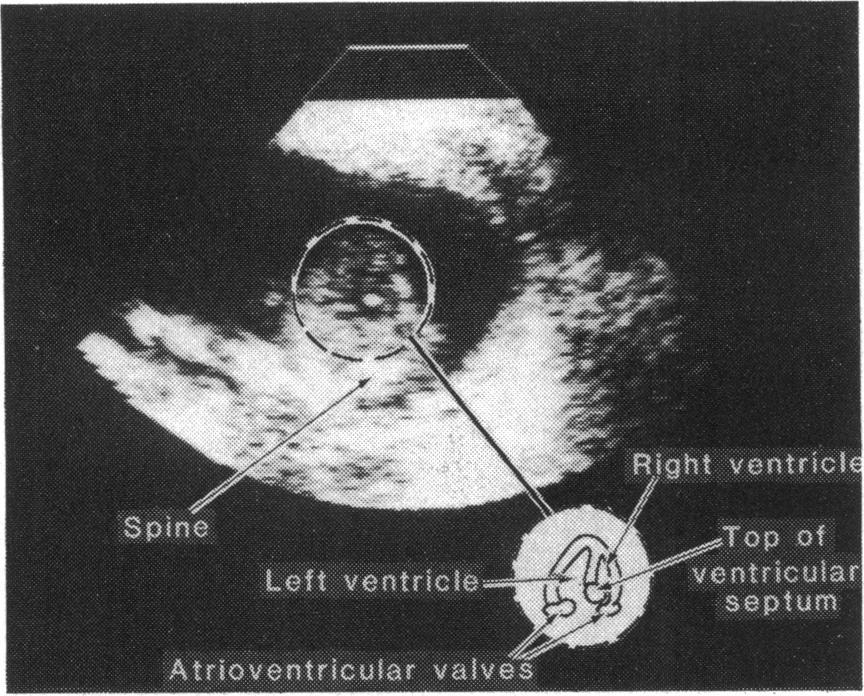 Identificatin of congenital cardiac malformations Fig. 1 Four chamber projection of 18 week gestation fetal heart. There appears to be a defect at the top ofthe ventricular septum.