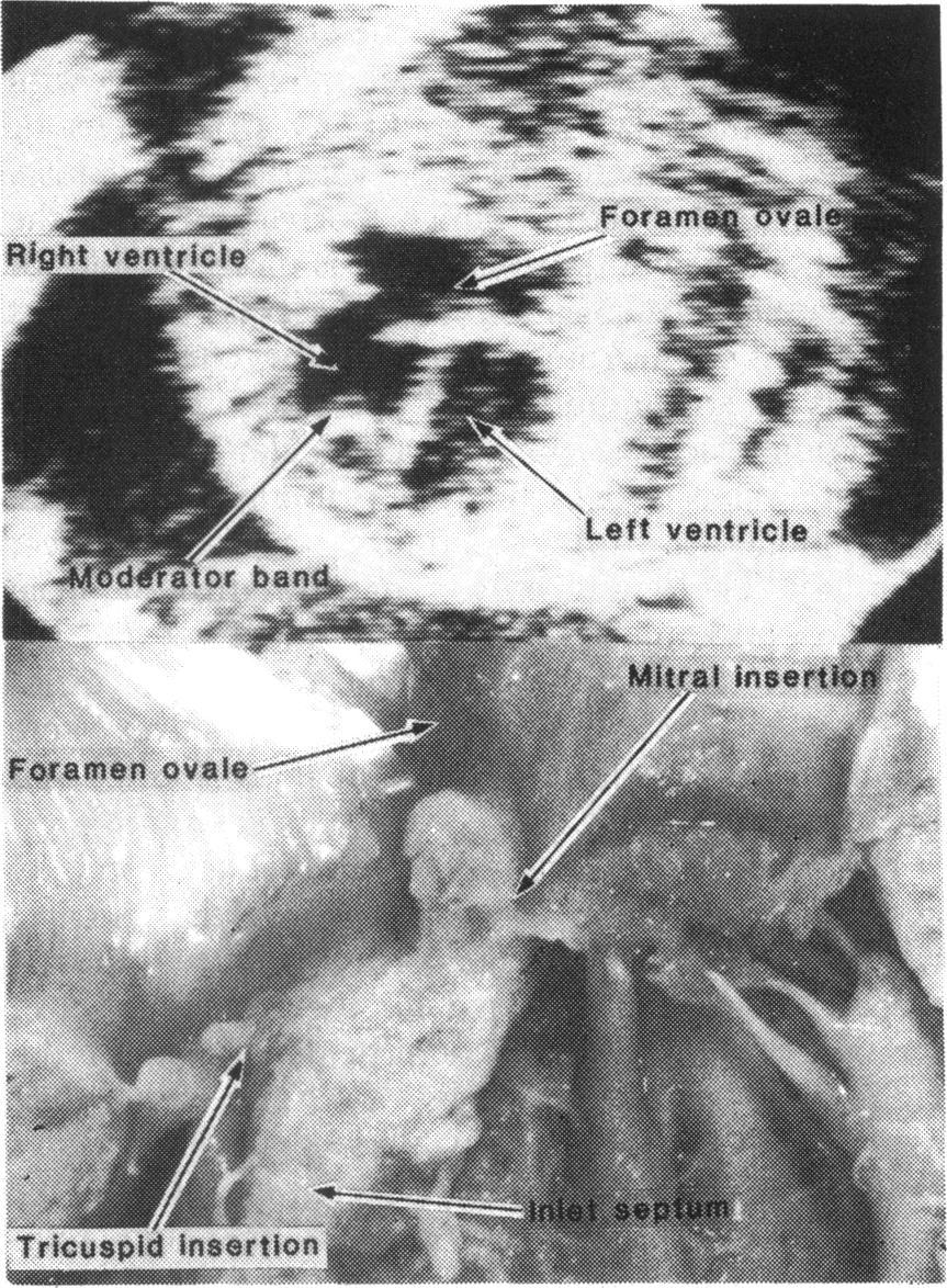 The difference in septal insertion of the mitral and tricuspid valves on a four chamber projection of the fetal heart is an important normal finding.