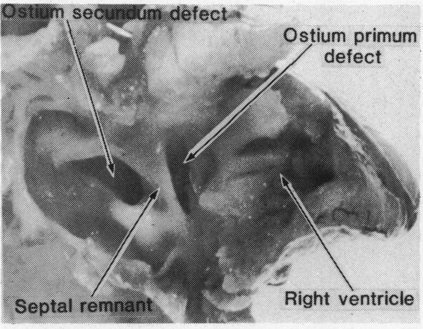 360 chamber view seen in Fig. 2a the atrial septum often shows dropout but on no projection of the heart with the atrioventricular defect could any atrial defect be detected.