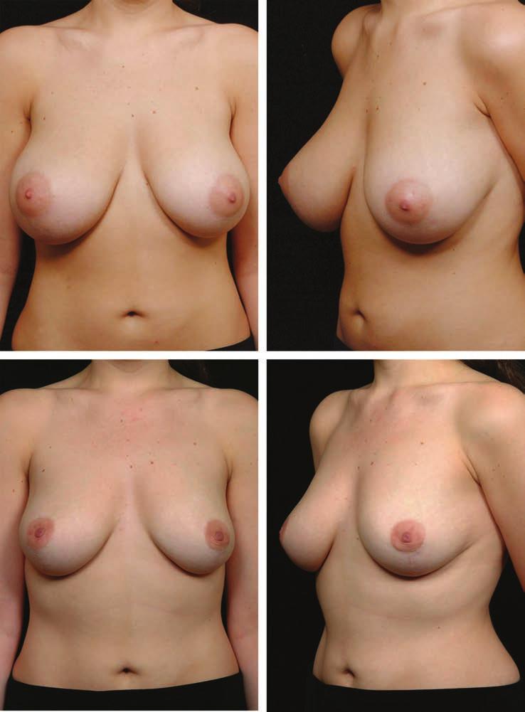 Volume 120, Number 7 Y-Scar Vertical Mammaplasty Fig. 1. Y-scar reduction. (Above) Preoperative views of a 24-year-old patient with a 32DD bra size. (Below) Postoperative views at 14 months.