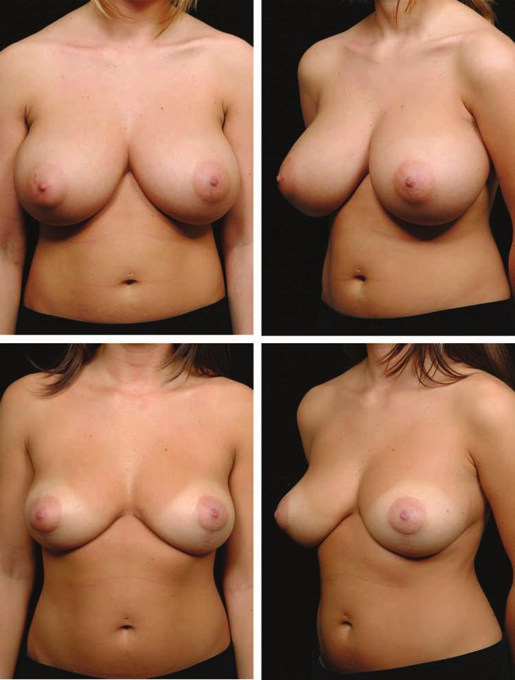 Plastic and Reconstructive Surgery December 2007 Fig. 2. Y-scar reduction. (Above) Preoperative views of a 20-year-old patient with a 32DD bra size. (Below) Postoperative views at 16 months.