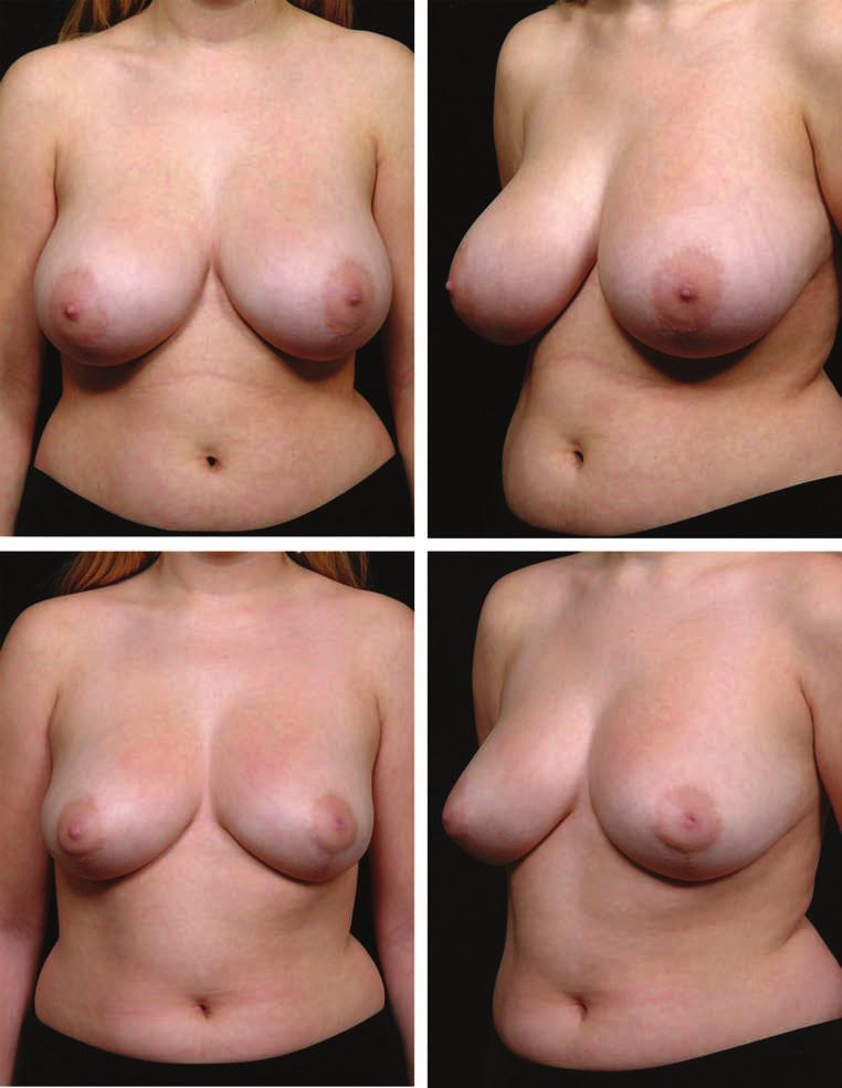 Volume 120, Number 7 Y-Scar Vertical Mammaplasty Fig. 3. Y-scar reduction. (Above) Preoperative views of a 22-year-old patient with a 34DDD bra size.