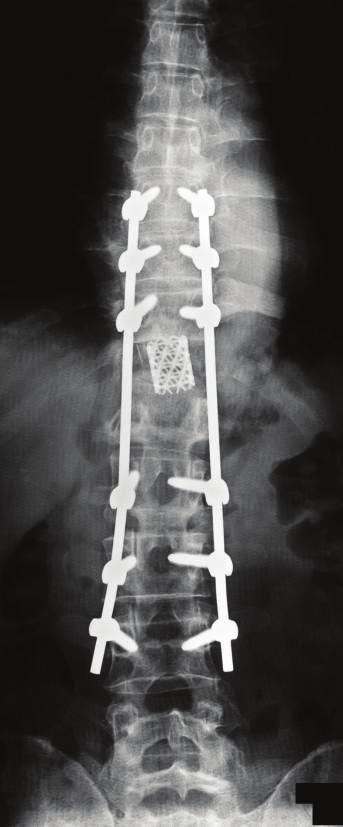 When resection was advanced to the root of the Th11 vertebral arch, potential was improved on electrospinographic monitoring. Pathological Findings.