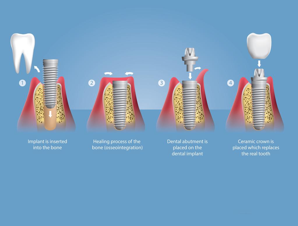 1 WHAT ARE DENTAL IMPLANTS? A dental implant is an artificial tooth that looks, feels, and functions like a real tooth. It is permanently attached to your jaw with an artificial root.