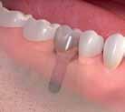 Straumann dental implants Treatment options.