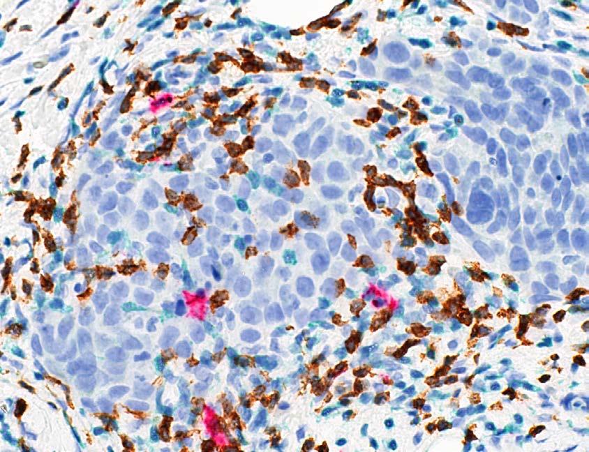Tumor-infiltrating lymphocytes (TIL) in