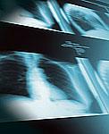 Chest X-Ray Discuss with health-care provider. Electrocardiogram (EKG/ECG) Discuss with health-care provider.