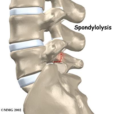 Anatomy What parts of the spine are involved? Introduction Spondylolysis happens when a crack forms in the bony ring on the back of the spinal column. Most commonly, this occurs in the low back.