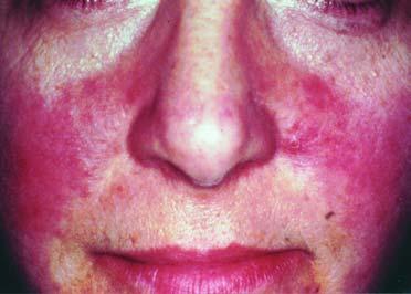 * Percentages of rosacea patients affected by the most common factors that may trigger rosacea flareups, based on a survey of more than 400 persons with rosacea by the National Rosacea Society.