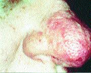 Steroid-induced acne presents with a more perioral distribution of the skin lesions. This distribution and a thorough history of medication use usually distinguish between the two conditions.