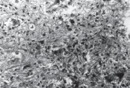 In case 2 and 3 the tumor was composed of fibrillary astrocytes (Figure 4).