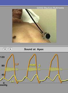 later Mitral regurgitation Chronic MR apex beat displaced to 7LICS outward excursion of