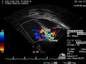 Regurgitation Acute severe, rapid heart rate Examination at 3LICS bounding (Corrigan's) pulse