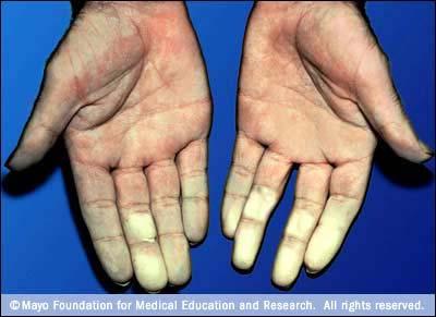 VERONICA EDMADZE ADDICO RAYNAUD S DISEASE Raynaud's disease is a rare vascular disorder that affects blood flow to the extremities (the fingers, toes,nose and ears)when exposed to cold temperatures