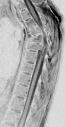 Paraplegia Bilateral Closed Femur Fractures Displaced Right Femoral Neck Fracture Left