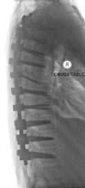 Thoracic Spine T-2 To T-