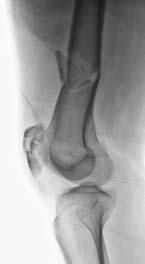 Knee Injuries Knee Injuries In 25% - 50% Patella Fractures Femoral