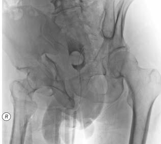 Fracture, Displaced Femoral