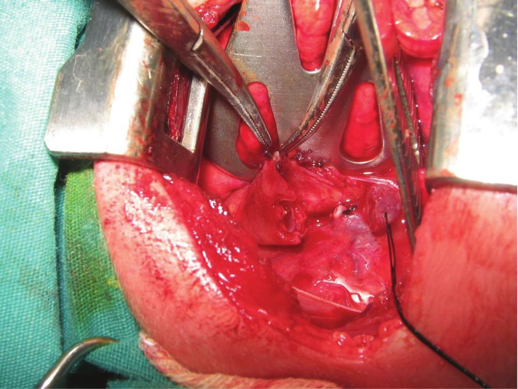 2 Gastroenterology Research and Practice Figure 1: The proximal esophageal pouch opened with plus + shaped incision.