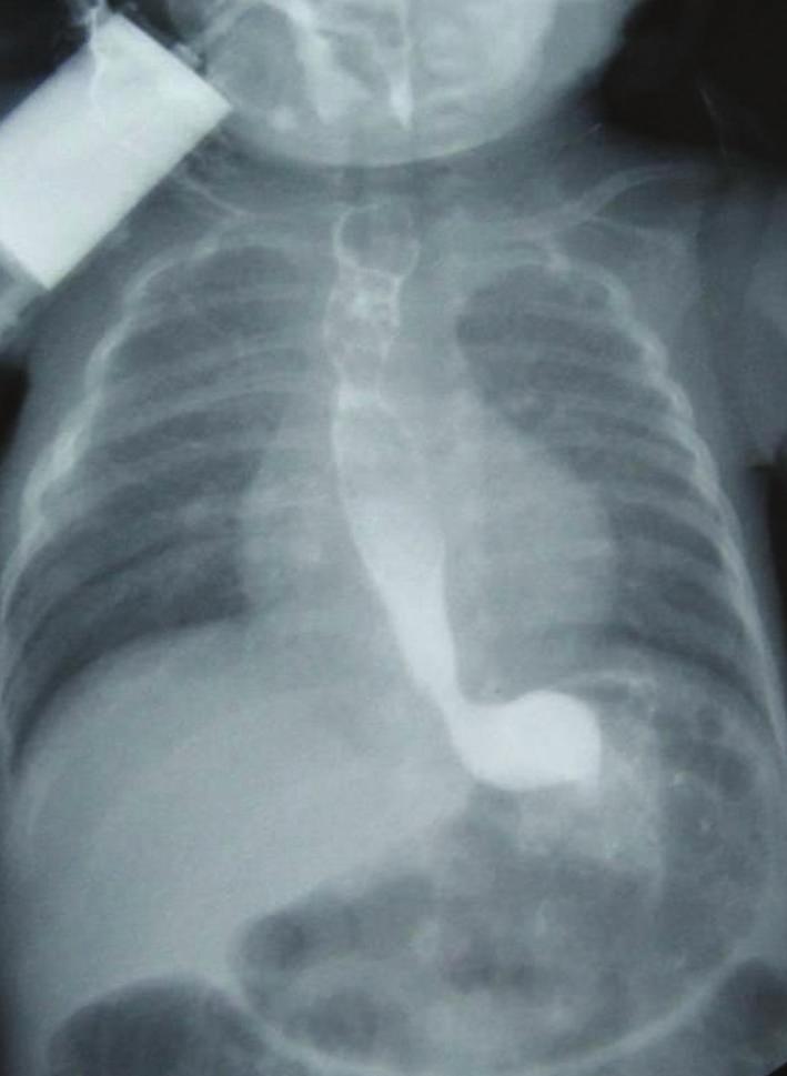 Gastroenterology Research and Practice 3 (a) (b) (c) Figure 3: (a) Normal esophageal passage X-ray view of the case with no anastomotic stricture.