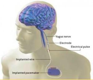Epilepsy Treatment- VNS Vagal Nerve Stimulator: Implanted device sends electrical pulse to vagus nerve About 1/3 of patients have had the number of their seizures reduced by half or more; less than