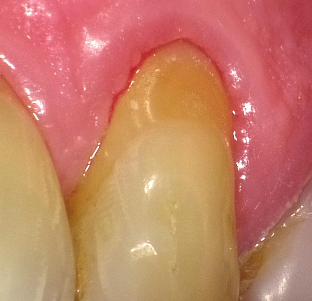 Exposed root surfaces need extra protection With an ageing population, root surface caries and cervical erosion have become a daily challenge.