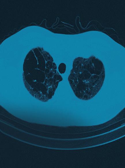 A primary care approach to interstitial lung disease When to suspect idiopathic