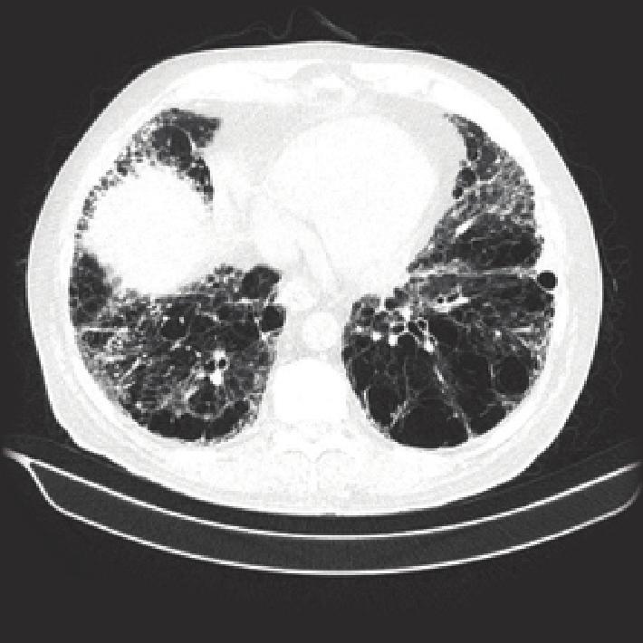 FIGURe 1 FIGURe 2 FIGURe 3 Figure 1. The findings in this image, taken at the apex of the lung, are mainly those of emphysema, with bullae and architectural distortion. Figure 2.