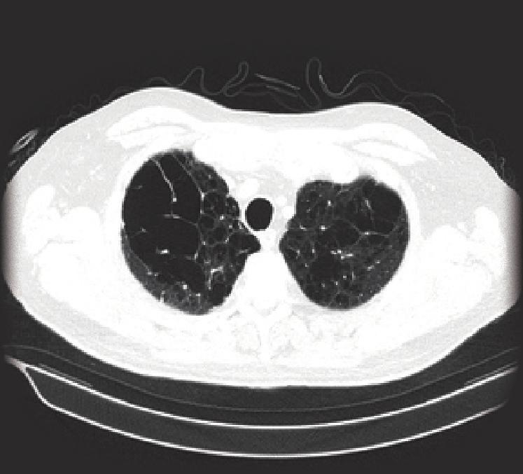 This is seen well in the right lung, but not so well in the left because of the extensive emphysema. Figure 3. Taken at the lung base, shows the extensive emphysema and fibrosis.
