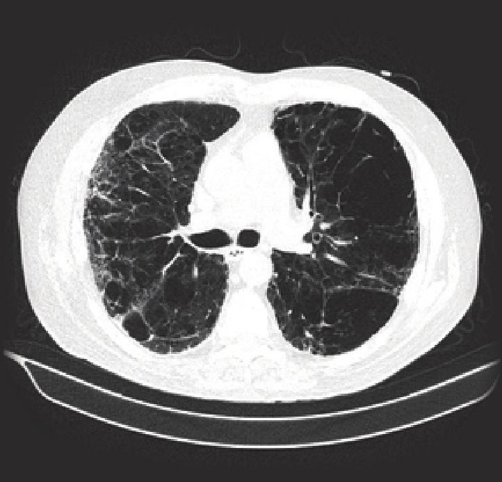 Extremities: Normal pulses, clubbing, no cyanosis, edema Neurology: Grossly intact The patient was sent for a high-resolution CT scan of the chest (Figures 1, 2, and 3) as well as pulmonary function
