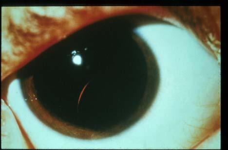 Homocystinuria Marfanoid features Skeletal abnormalities Osteoporosis Dislocated lenses Mental
