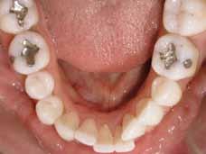 Between pretreatment and posttreatment, the anterior teeth have