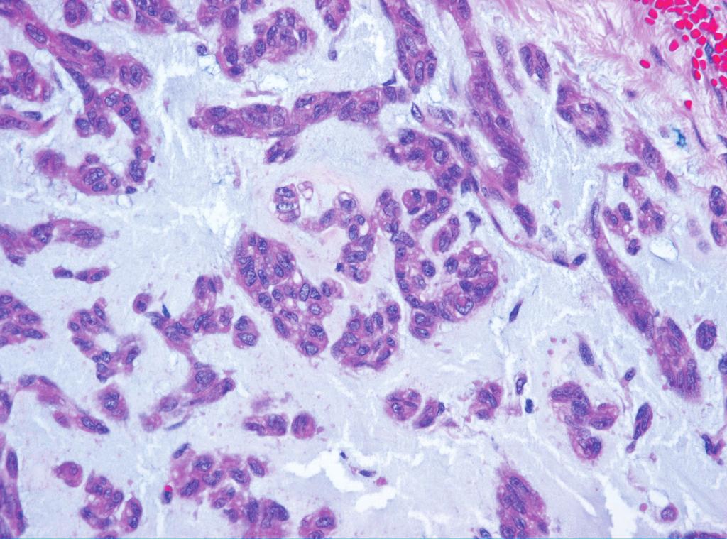 (A) The cancer cells float in the mucoid matrix and form small irregular cords and nests and the cancer cells have moderate eosinophilic cytoplasm and well-defined margins.