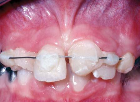 Figure 2 Photograph of splinted maxillary incisors 2 weeks after injury (A).
