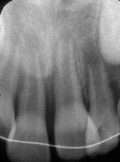 . Figure 5 Photograph of maxillary incisors 12 months after injury (A).