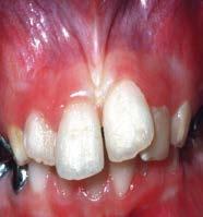 Photograph of maxillary incisors 18 months after injury (C).