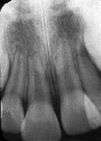 Photograph of maxillary incisors 24 months after injury (E).
