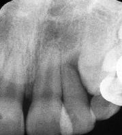 Radiograph of maxillary incisors 2 ½ years after injury (B).