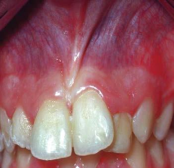 The right lateral incisor and the right and left central incisors showed continued root growth