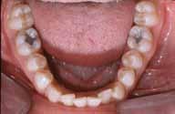was not pleasing because of the labioversion of tooth #23 and palatoversion of