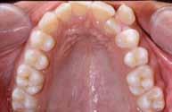 Intraoral examination revealed Angle Class I malocclusion and anterior